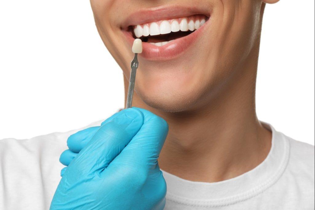 porcelain veneers in burnaby