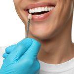 porcelain veneers in burnaby